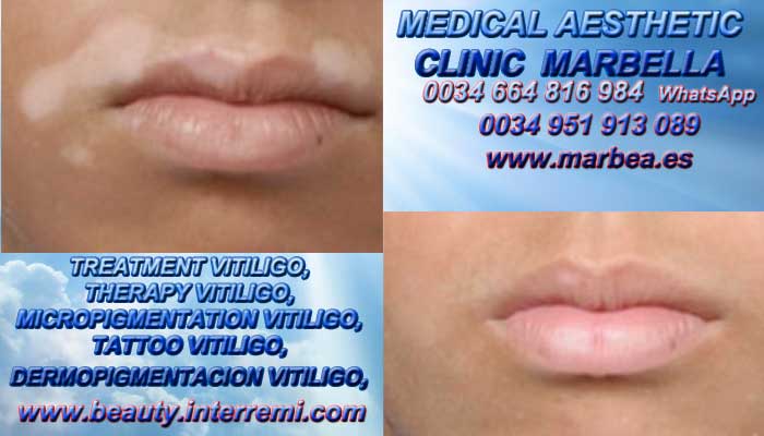 ANTI VITILIGO clínica estética maquillaje permanete propone Tratamiento Para El Vitiligo en Marbella y Málaga.