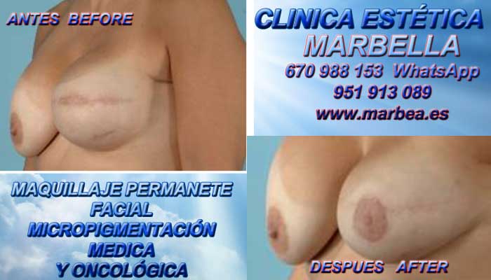 cicatrices mamaria Tratamiento cicatrices luego de reduccion MAMARIA en Marbella or Puerto Banus. Microblading Marbella y en Frontera. en Microblading Marbella y en Fuengirola