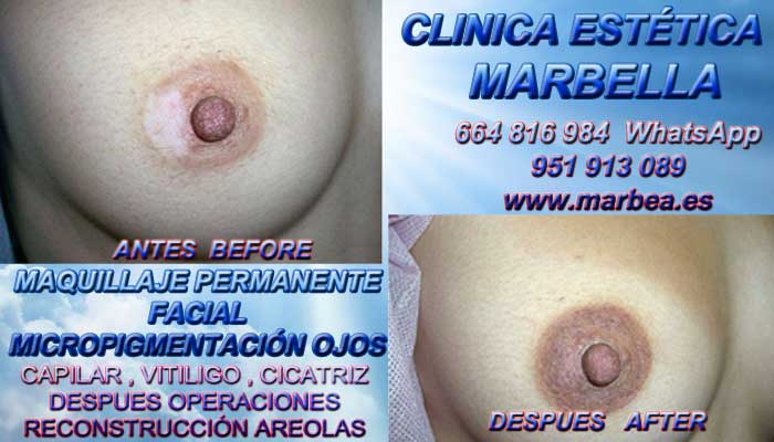 cicatrices mamaria Tratamiento cicatrices luego de reduccion PEZÓN en Marbella y Nerja. Pigmentacion Marbella y Huelva. en Microblading Marbella y en Torremolinos