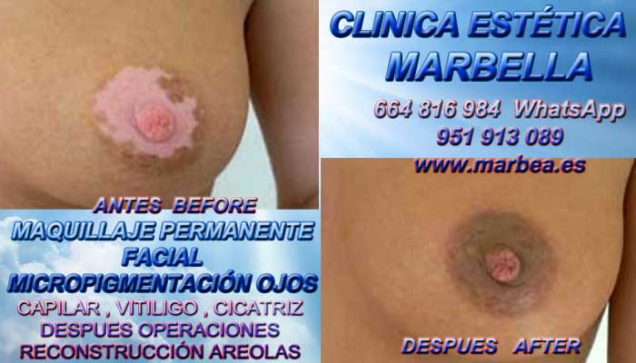 cicatrices mamaria Tratamiento cicatrices después de reduccion MAMAS en Marbella y Huelva. Pigmentacion Marbella y en Granada. en Microblading Marbella y en Madrid