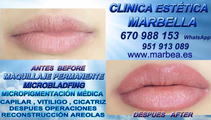 Aumento de labios marbella camuflaje para rejuvenecer parpados sin cirugia aumento de labios marbella