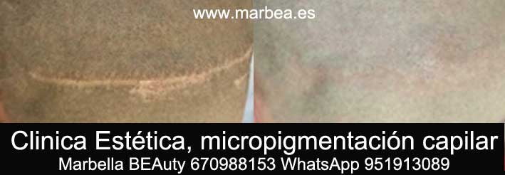 CICATRIZ EN LA CABEZA CLINICA ESTÉTICA micropigmentación capilar en Marbella y maquillaje permanente en marbella