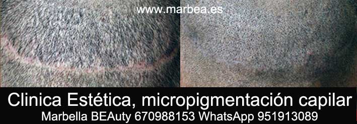 CICATRIZ EN LA CABEZA CLINICA ESTÉTICA tatuaje capilar en Marbella y maquillaje permanente en marbella