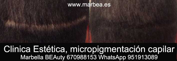 TAPAR CICATRIZ EN LA CABEZA CLINICA ESTÉTICA micropigmentación capilar en Marbella y maquillaje permanente en marbella