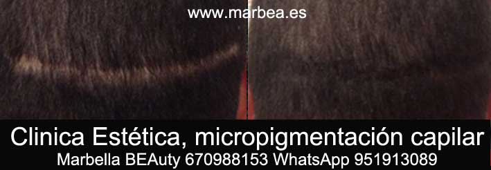 TAPAR CICATRIZ EN LA CABEZA CLINICA ESTÉTICA micropigmentación capilar Marbella y maquillaje permanente en marbella