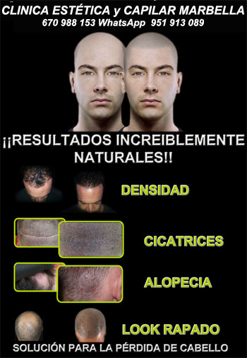micropigmentación capilar Almería Clínica Estética y tratamiento de la alopecia areata Marbella: Te ofrecemos la mayor calidad de servicios micropigmentación capilar Almería 