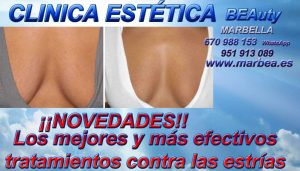 Clinica Estética Marbella, rejuvenecimiento facial sin cirugía reducción arrugas Marbella, relleno arrugas Marbella  belleza Marbella. Corrección las arrugas Marbella, eliminacion arrugas Marbella arrugas borrar Marbella. Tratamiento de arrugas Marbella, Marbella - corrección las arrugas. Liposucción sin cirugía Marbella, blefaroplastia Marbella. Aumento labios Marbella, relleno facial Marbell Eliminación ojeras Marbella. Tratamiento celulitis marbella, rejuvenecimiento facial Marbella. Estrías Marbella, rejuvenecimiento Marbella. 4-300x171 Estrías Marbella, tratamiento para eliminar las estrías Marbella estrías blancas Marbella. Tratamiento contra estrías Marbella, tratamientos estrias Marbella tratamiento contra estrías Marbella. Eliminación de estrías Marbella eliminar estrias Marbella estrías blancas Marbella estrías después del embarazo Marbella estrías en el embarazo Marbella estrías en el pecho Marbella ESTRÍAS MARBELLA estrías moradas Marbella estrías rojas Marbella estrías vascular Marbella quitar estrias Marbella Tratamiento Contra Estrías Marbella Tratamiento para eliminar las estrías Marbella tratamientos estrias Marbella