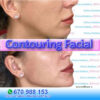 Contouring en Clinica Estetica Marbella. Rejuvenecimiento Facial Marbella con relleno mandibula,remodelacion facial Marbella.