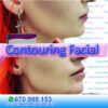 Contouring en Clinica Estetica Marbella. Rejuvenecimiento Facial Marbella con relleno mandibula,remodelacion facial Marbella.