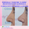 nariz sin cirugia marbella rinoplastia sin cirugia marbella. Rinomodelación Sin Cirugía marbella,