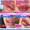 Aumento de labios en Marbella, acido hialuronico para los labios en marbella. Relleno de labios en marbella volumen labios marbella