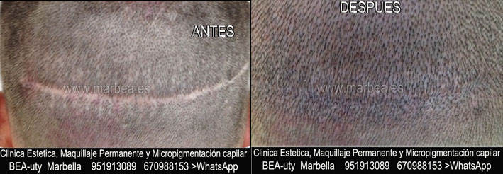 eliminar cicatriz cuero cabelludo CLINICA ESTÉTICA dermopigmentacion capilar Málaga y maquillaje permanente en Málaga ofrece: dermopigmentacion capilar , tatuaje capilar