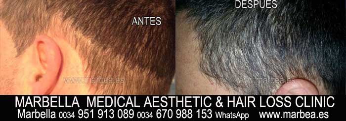 MEDICAL MICROPIGMENTATION FOR ALOPECIA welcome to the permanent makeup marbella clinic beauty , the biggest permanent makeup center in marbella - spain