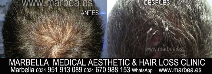 SCALP TINTING welcome to the permanent makeup marbella clinic beauty , the biggest permanent makeup center in marbella - spain
