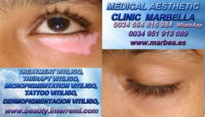 MEDICAL AESTHETIC CLINIC MARBELLA ofert TREATMENT VITILIGO eyeliner y eyebrow