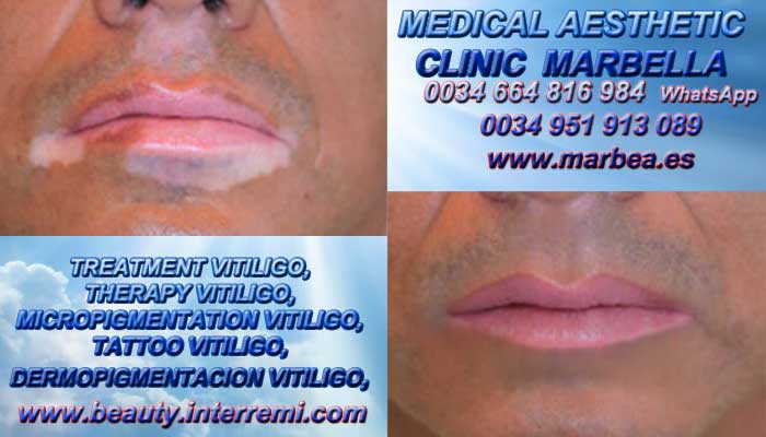 TRATAMIENTO PARA LAS MANCHAS DE VITILIGO clínica estética maquillaje permanete entrega Tratamiento Para El Vitiligo
