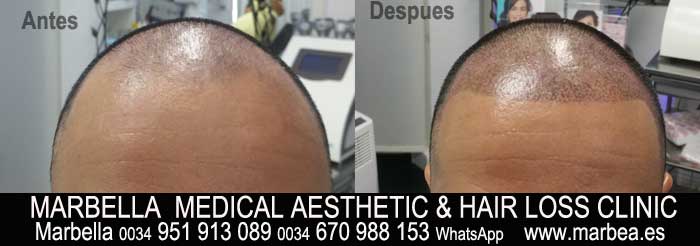 TATTOO HAIR SIMULATION MARBELLA Welcome to the PERMANENT MAKEUP MARBELLA CLINIC BEAuty , the biggest permanent makeup center in MARBELLA - Spain