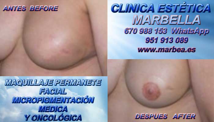 TRATAMIENTO CICATRIZ MAMARIA clínica estética tatuaje propone camuflaje cicatrices post reduccion de senos
