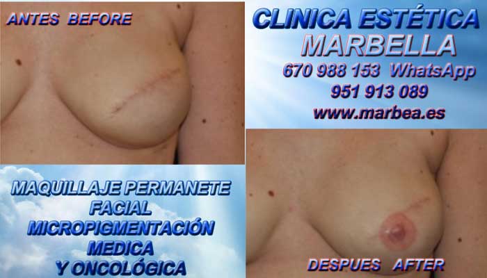 RECONSTRUCCION AREOLA PEZON TATUAJE clínica estética delineados entrega camuflaje cicatrices posteriormente de reduccion de pechos