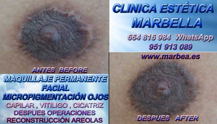 TRATAMIENTO CICATRIZ MAMA clínica estética maquillaje permanete ofrenda tratamiento cicatrices posteriormente de reduccion mamas