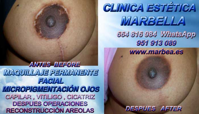 RELLENOS AREOLAS clínica estética micropigmentación ofrenda tratamiento cicatrices posteriormente de reduccion de mamaria