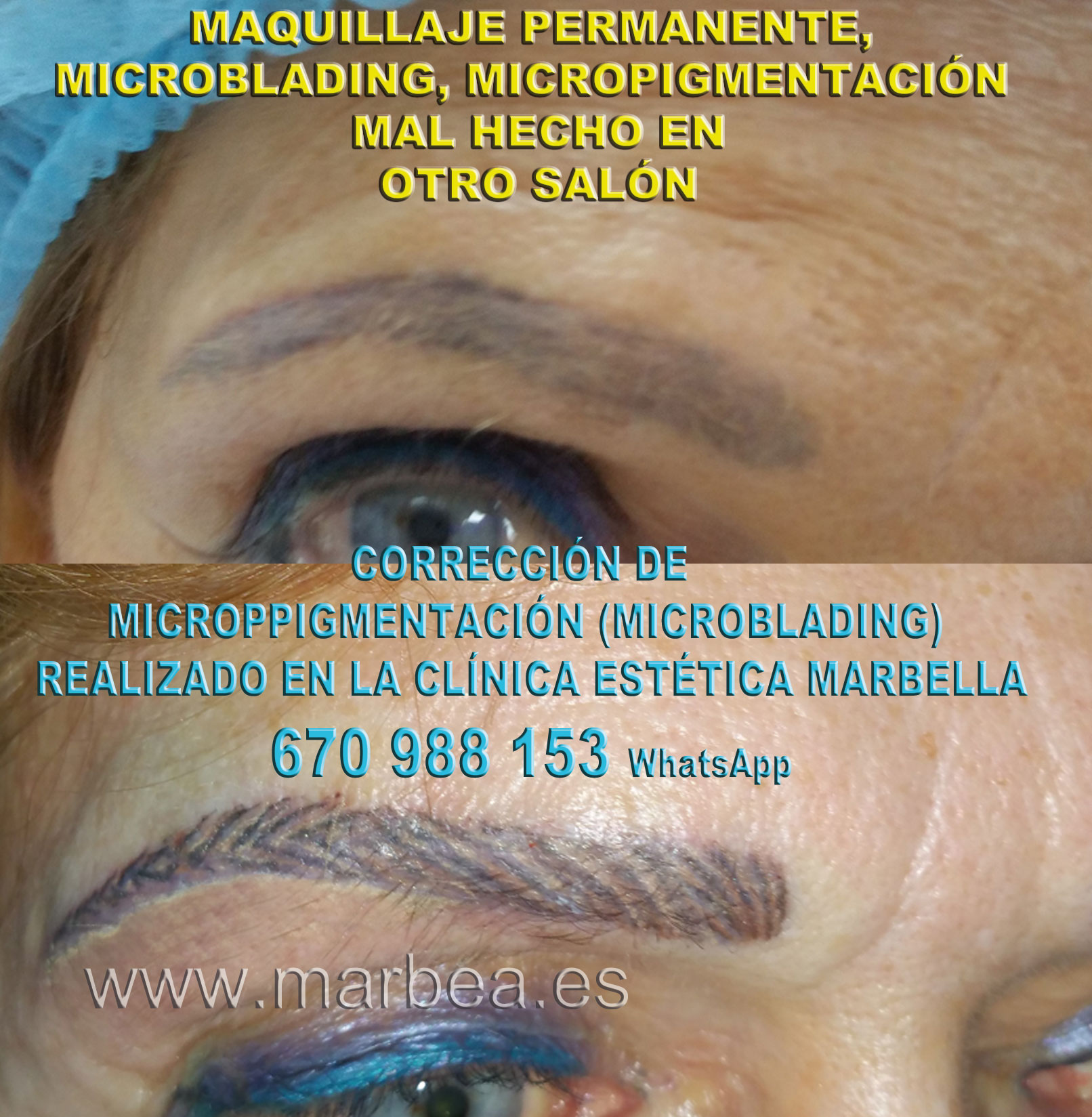 Borrar micropigmentación mal hecha clínica estética micropigmentación propone como aclarar la micropigmentación cejas,corregir micropigmentación no deseada