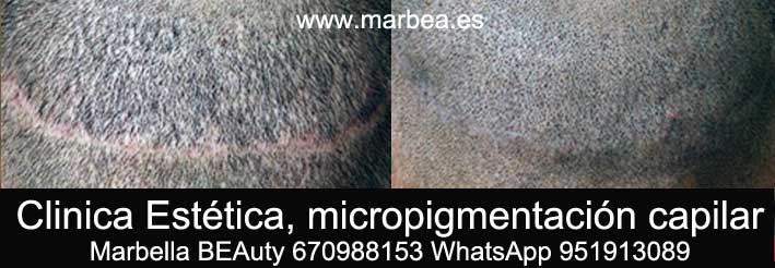 eliminar cicatriz cuero cabelludo CLINICA ESTÉTICA micropigmentación capilar Málaga y maquillaje permanente en Málaga