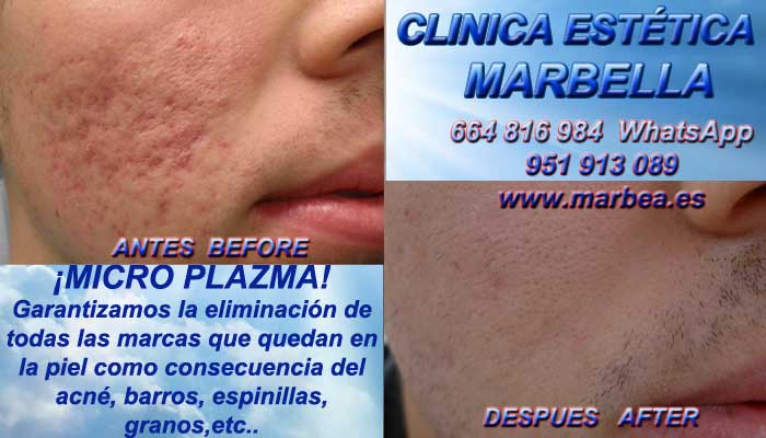  Tratamientos para cicatrices de acné Algeciras Tratamientos para cicatrices de acné, tratamientos para borrar cicatrices de acné. Tratamientos para borrar manchas de acné y Jérez